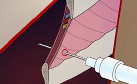 Interventional Pulmonologist in Delhi